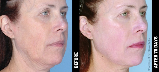 before-after ultherapy face